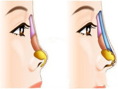 自體軟骨隆鼻能維持多久?