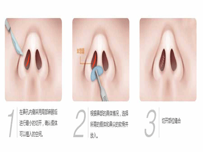 隆鼻整形失敗的修復的最佳時機