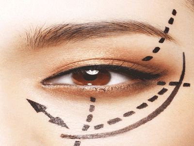 韓式雙眼皮失敗了也能修復嗎，方法是什麼