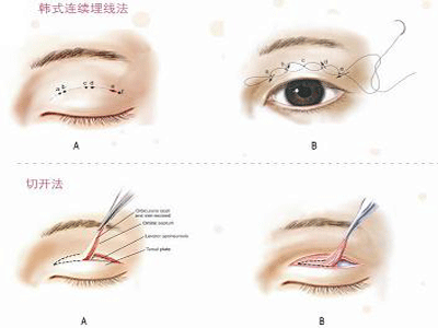 微創雙眼皮術的技術效果