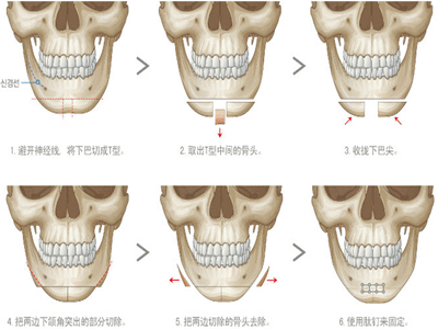 下巴整形的方法有哪些