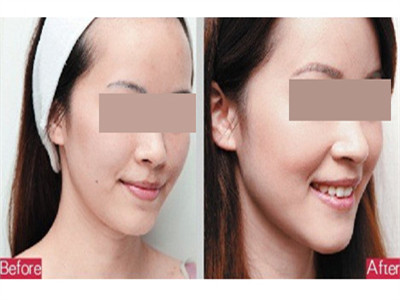 彩光嫩膚可以改善皮膚粗糙情況嗎？