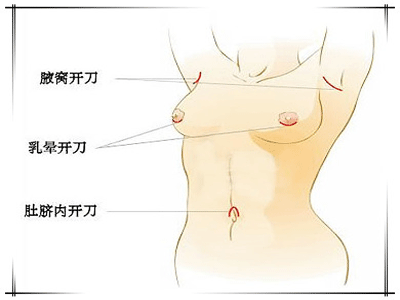 豐胸手術哪一種比較便宜?