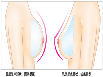 假體隆胸術後怎麼護理？