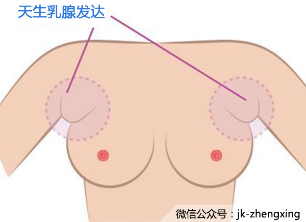 納尼？年紀輕輕長副乳了？趕緊滅了它~