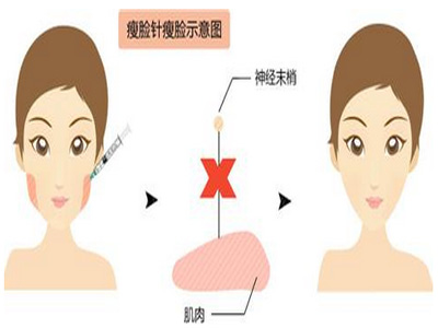 吸脂減雙下巴術後注意事項