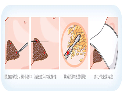 告訴你吸脂的真相!!