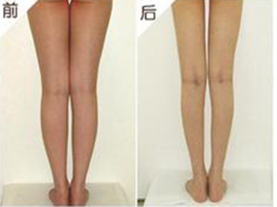最為常見的吸脂瘦腿的副作用