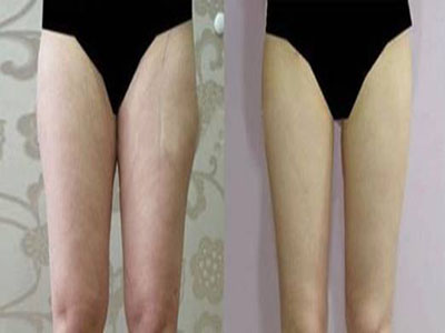 瘦人也能做吸脂瘦腿術嗎？