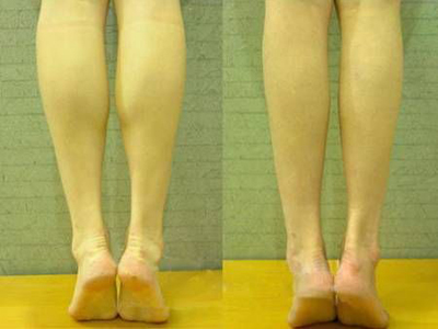 認識吸脂瘦腿的副作用