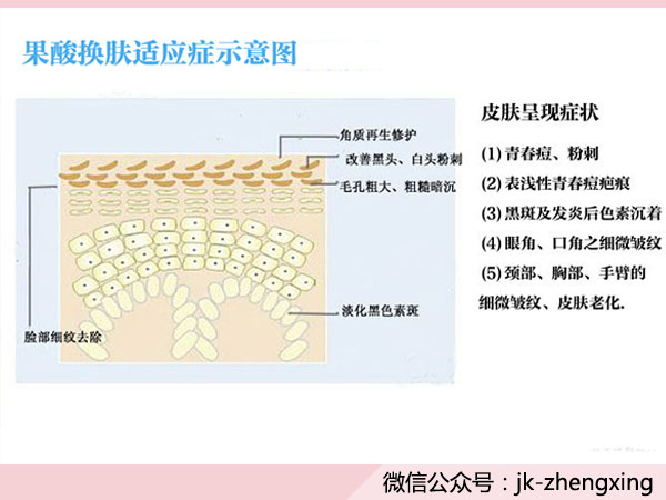 想重現蛋殼肌膚？5種手術幫你治療痘印