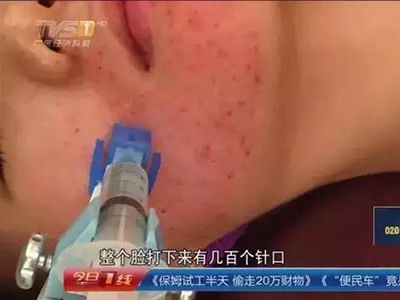 打水光針毀容 水光針副作用有哪些