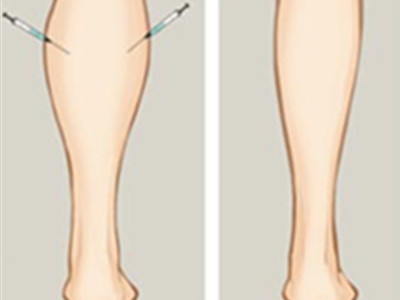 解答注射肉毒桿菌瘦腿的問題