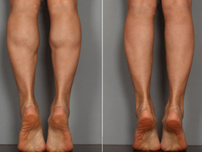 講解瘦腿的有效方法都有哪些