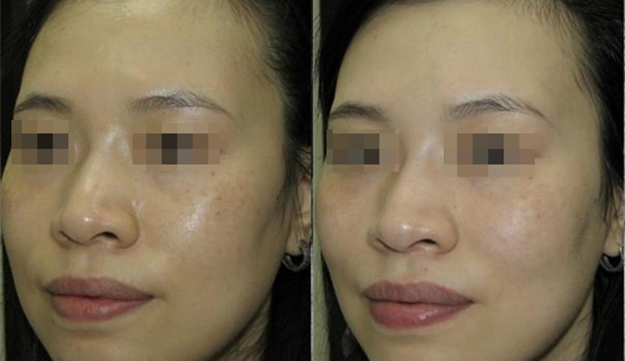 激光祛斑副作用→_→皮膚變薄更敏感或干裂？