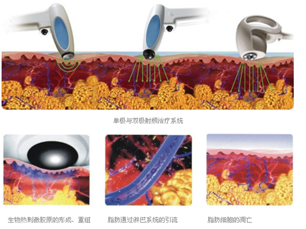 射頻除皺後能立即上班嗎？