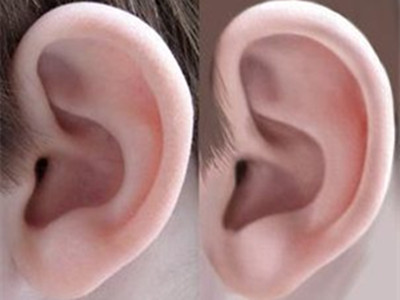 治療杯狀耳的方法有哪些