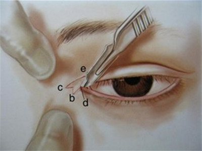開眼角疤痕的恢復期是多久