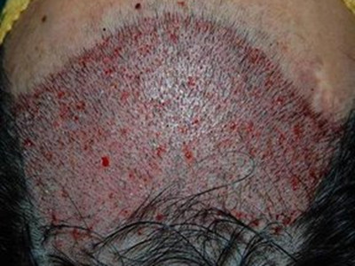 毛發移植術前術後該怎麼做？