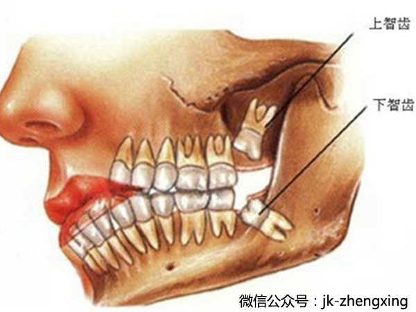 拔智齒可以瘦臉？別再被那些女明星忽悠啦！