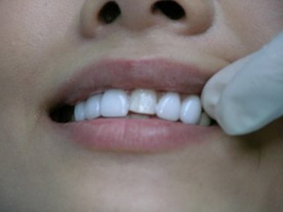 不同類型的牙齒整形方法