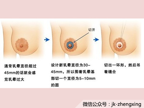 隱秘整形︳唠唠乳頭乳暈重建術~