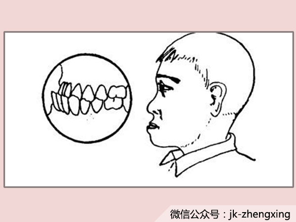 並非我有意“癟嘴”，是因為我天生就是“癟嘴”~