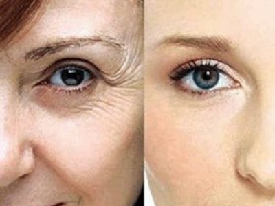 微整形術幫助女性對抗面部衰老