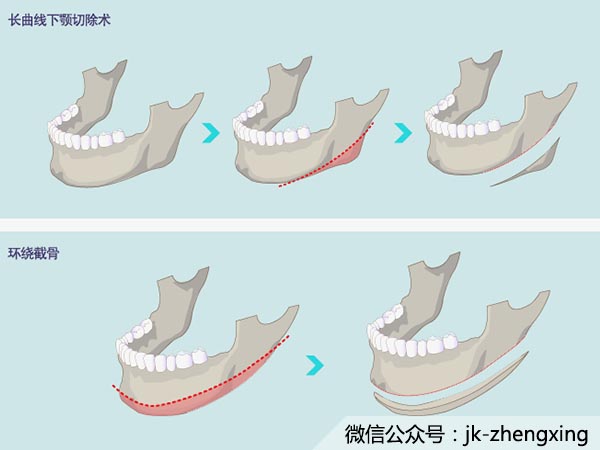 【整形誤區】知道這幾大整形常識，幫你避免誤區（二）