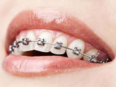 矯正牙齒是不是一定要分牙？