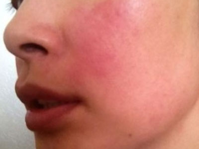 面部皮膚過敏瘙癢怎麼辦？