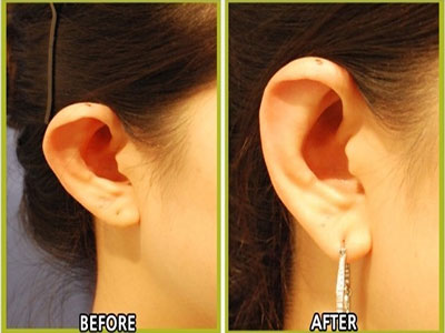 耳朵整形醫院介紹畸形耳矯正術