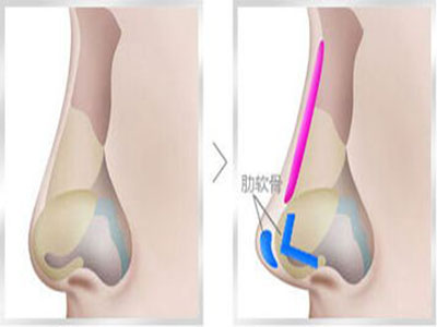 軟骨隆鼻後遺症