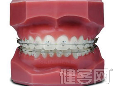 牙齒保持器圖片