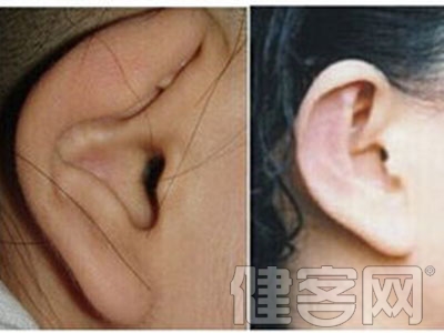 杯狀耳的特征和手術適應症介紹
