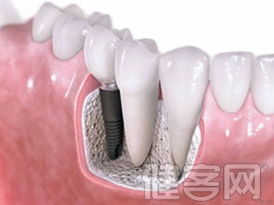 牙齒缺失修復方法