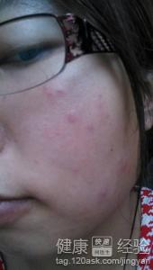 停用祛斑霜後臉紅癢起紅疙瘩是副作用嗎