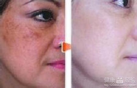 祛斑的小妙招有什麼