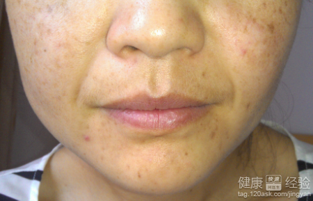 長有黃褐斑要補充哪些微量元素
