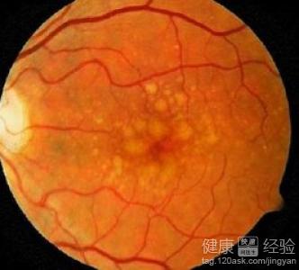 眼睛血管堵塞硬化和黃斑變性是否一樣