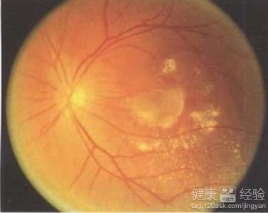 診斷雙眼黃斑變性早期發現有什麼優勢