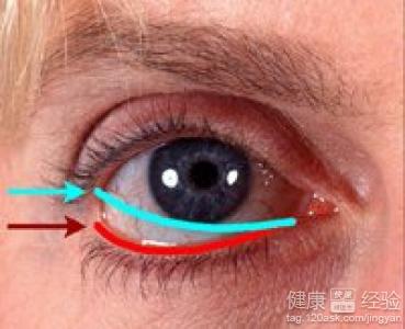 雙眼年齡相關黃斑變性的危害與不便