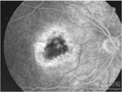 眼底黃斑變性分別有哪些以及分別怎麼治