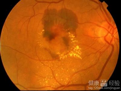 干型黃斑變性的治療方法