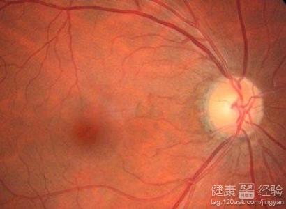 黃斑變性視神經萎縮做過OCT復發了怎麼辦