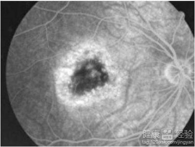 干性黃斑變性，視神經萎縮治療要避開哪些誤區