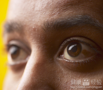 老年眼底黃斑變性怎麼治療法最合適