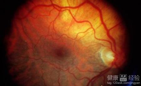 遺傳性黃斑變性導致視野缺損早期治療很重要