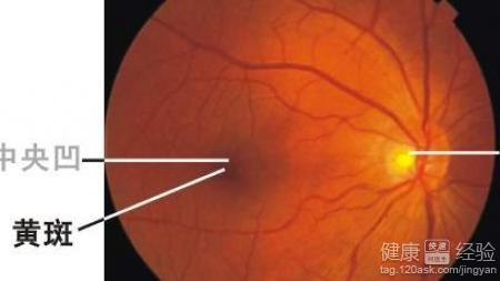 視網膜黃斑變性如何醫治