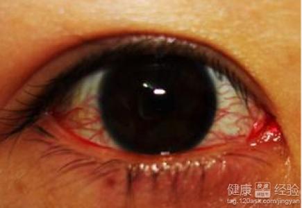 孩子黃斑變性怎麼治療預後怎麼保護自己的眼睛